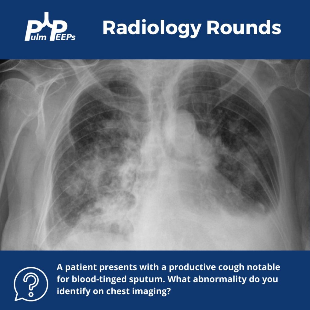 Radiology Rounds 2: Diffuse Alveolar Hemorrhage