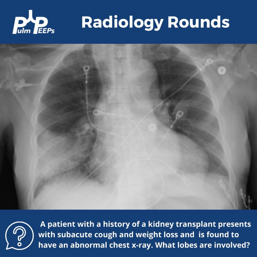 Radiology Rounds 1: Nocardiosis