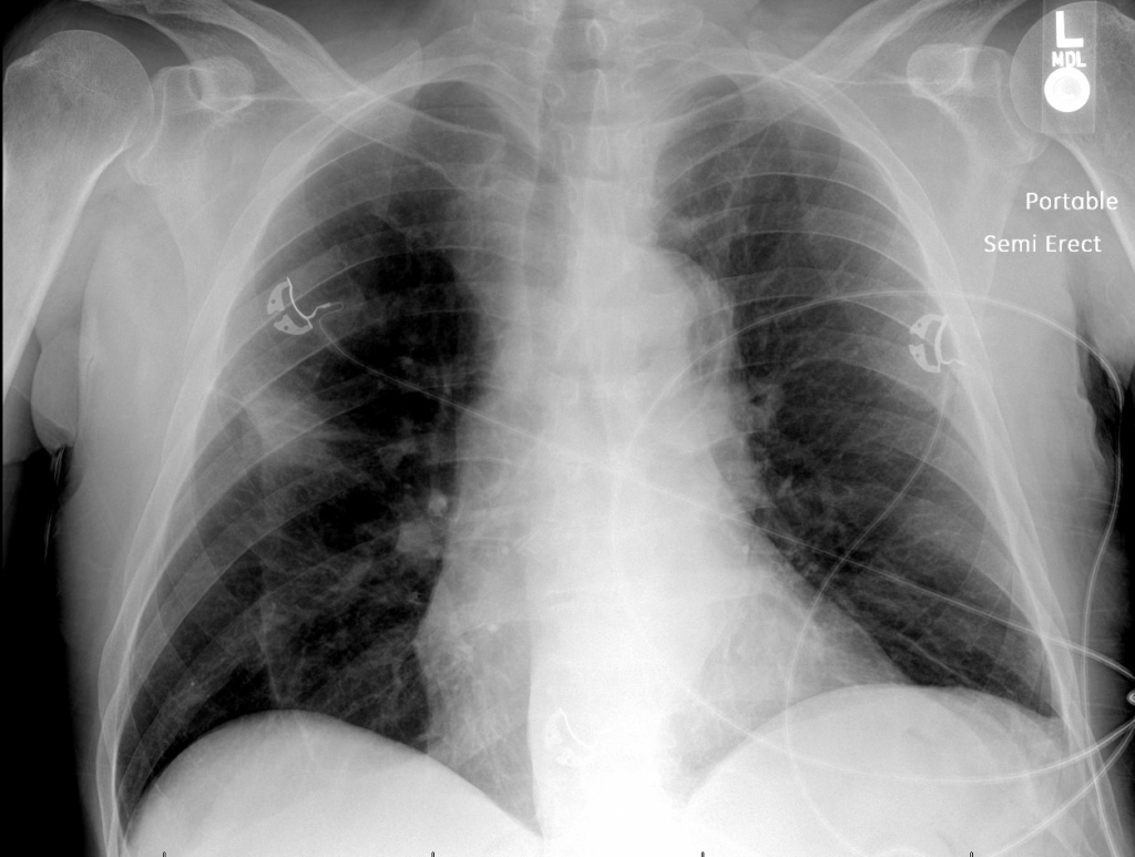 M-Mode for Pneumothorax  Emory School of Medicine