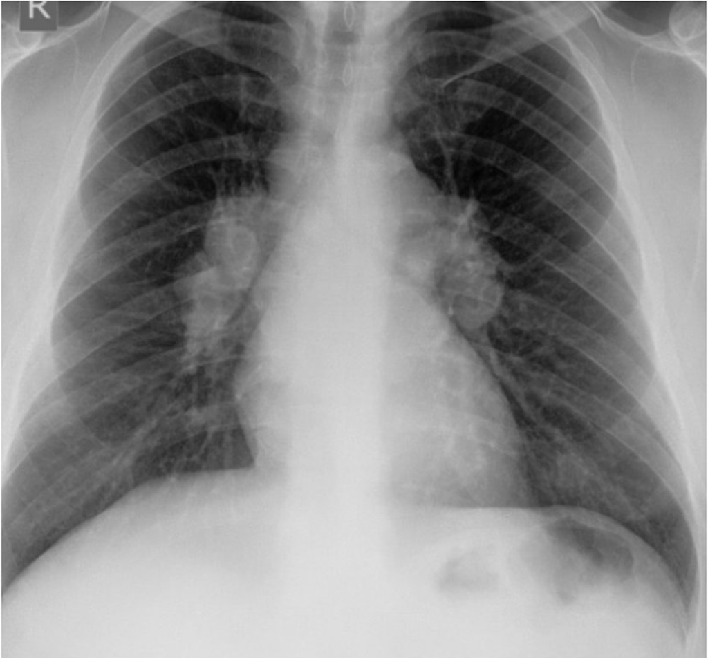 Radiology Rounds 52: Sarcoid 1-2-3 Sign